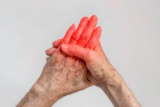 Mãos de pessoa idosa com vermelhidão e inflamação nas articulações, representando doenças reumáticas e dores articulares comuns.